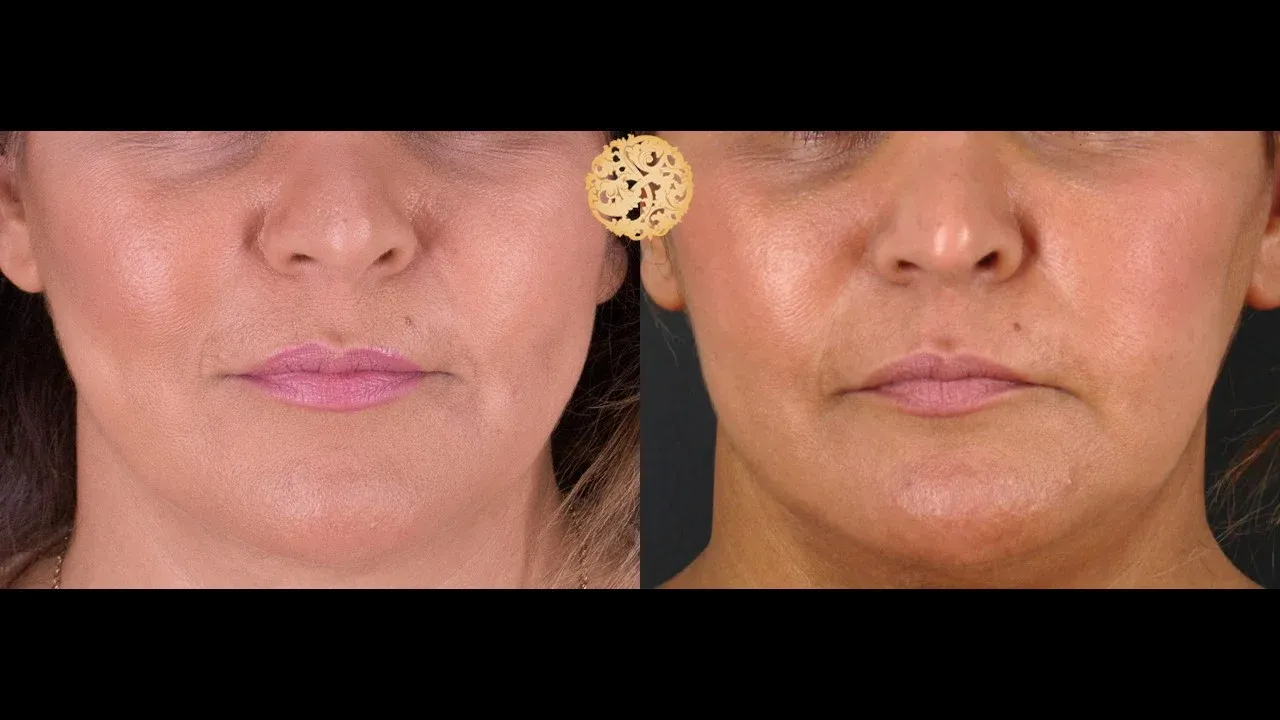 Buccal Fat Removal Before & After