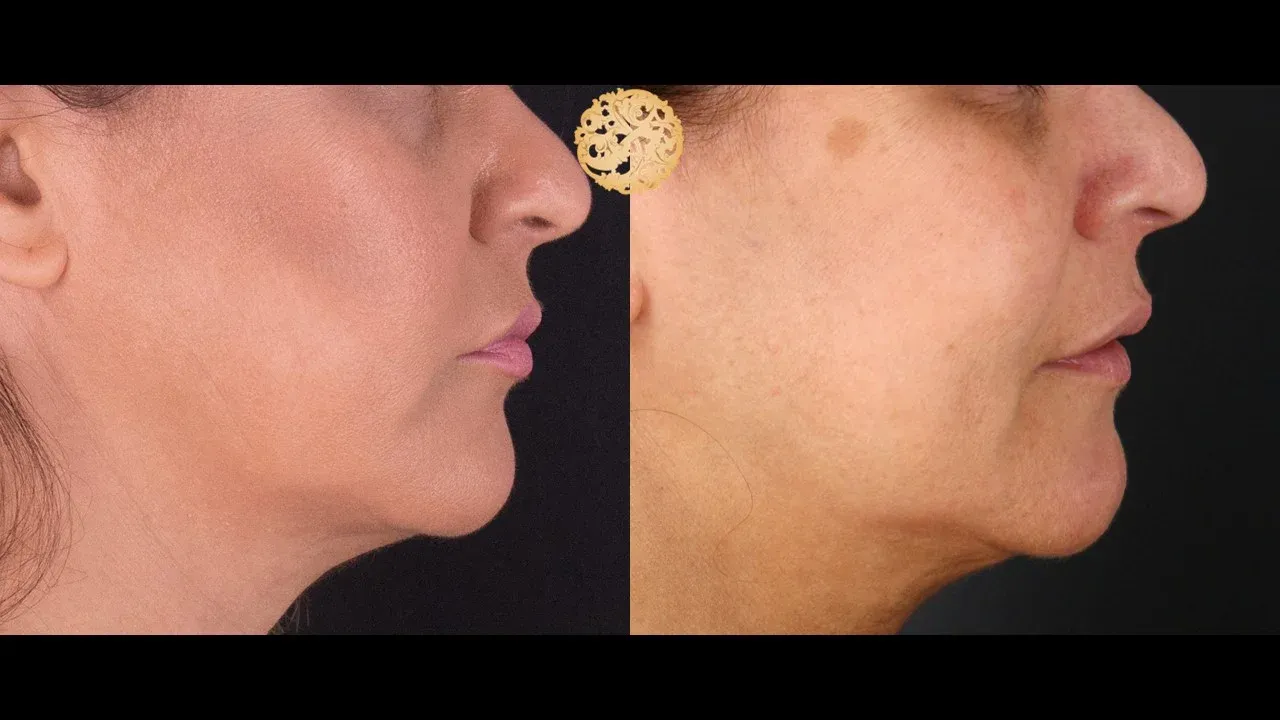 Buccal Fat Removal Before & After