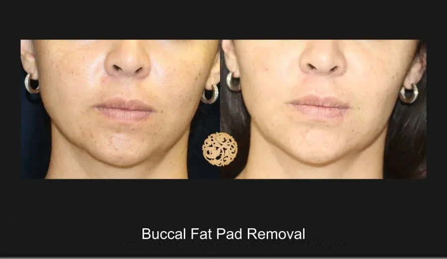 Buccal Fat Removal Before & After