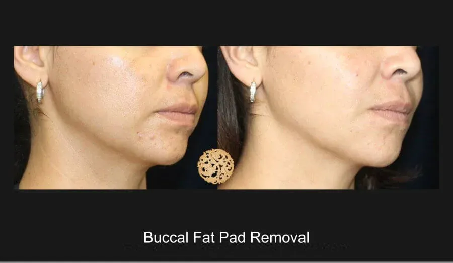 Buccal Fat Removal Before & After