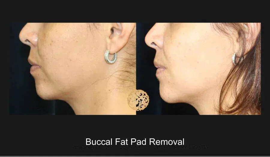 Buccal Fat Removal Before & After