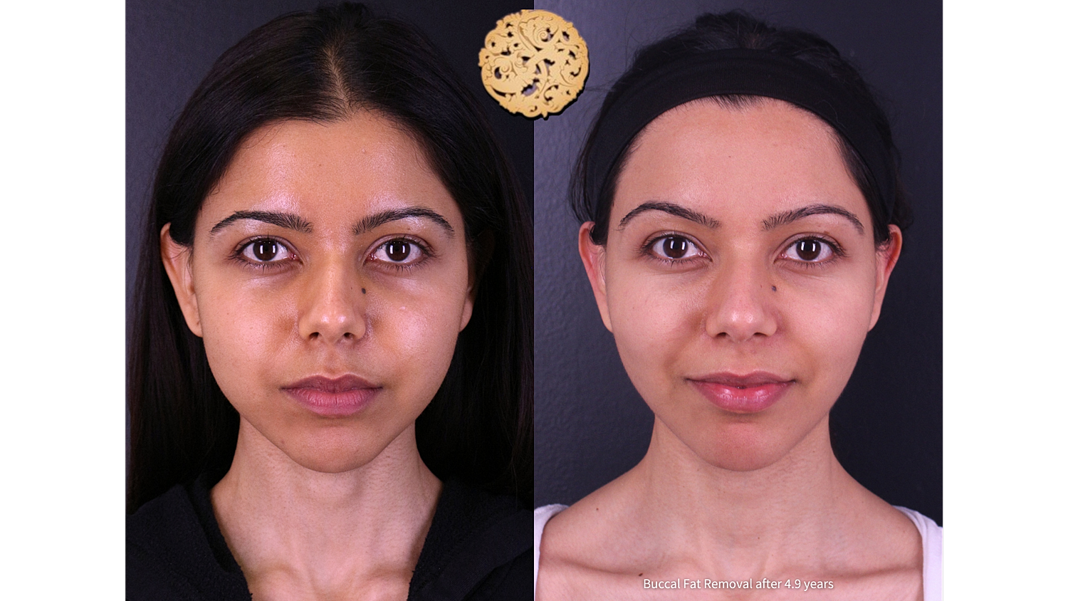 Buccal Fat Removal After 4.9 Years