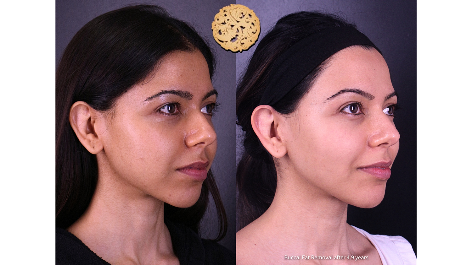 Buccal Fat Removal After 4.9 Years