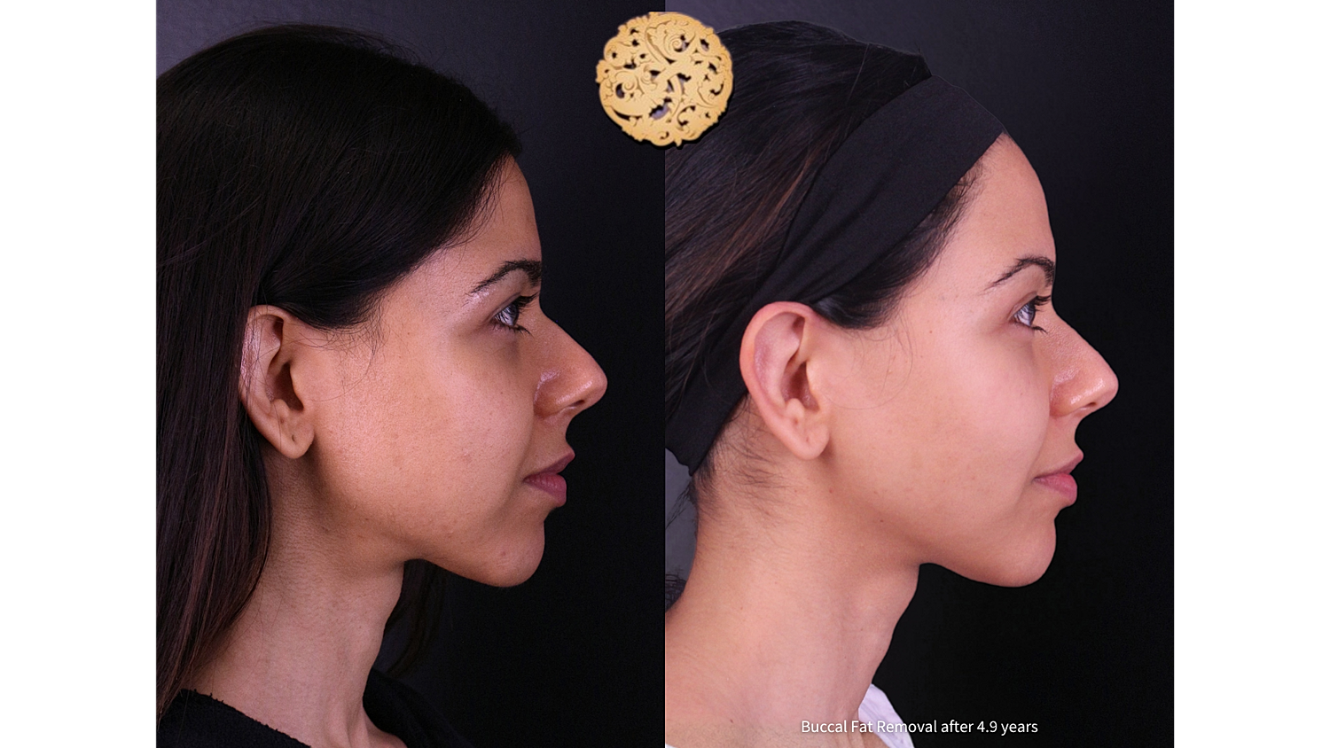 Buccal Fat Removal After 4.9 Years