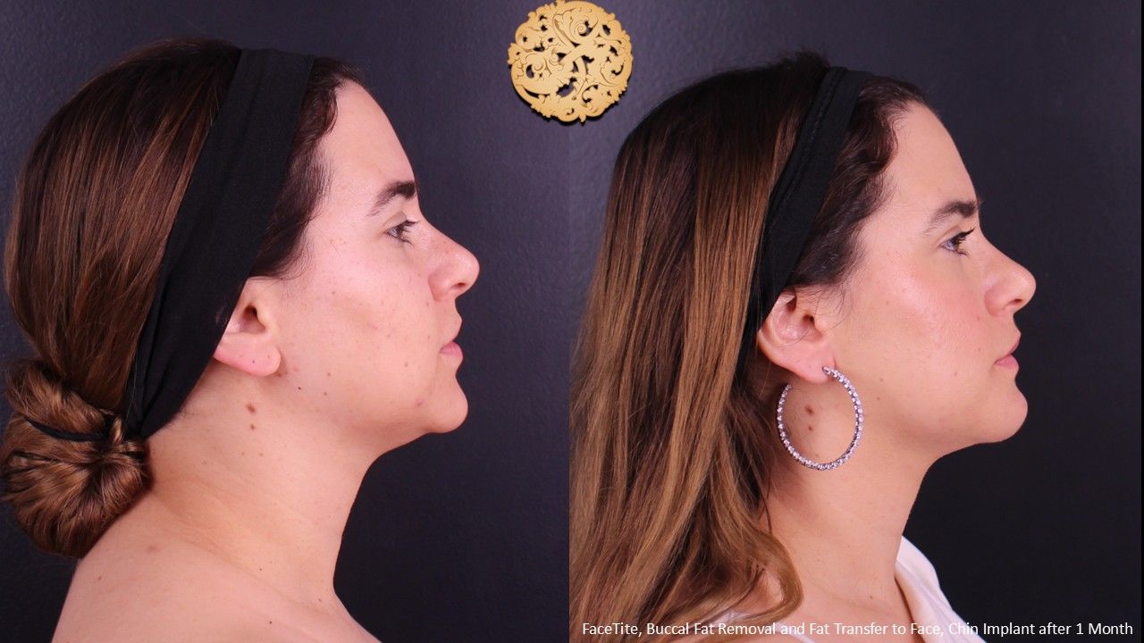 Buccal Fat Removal Before & After