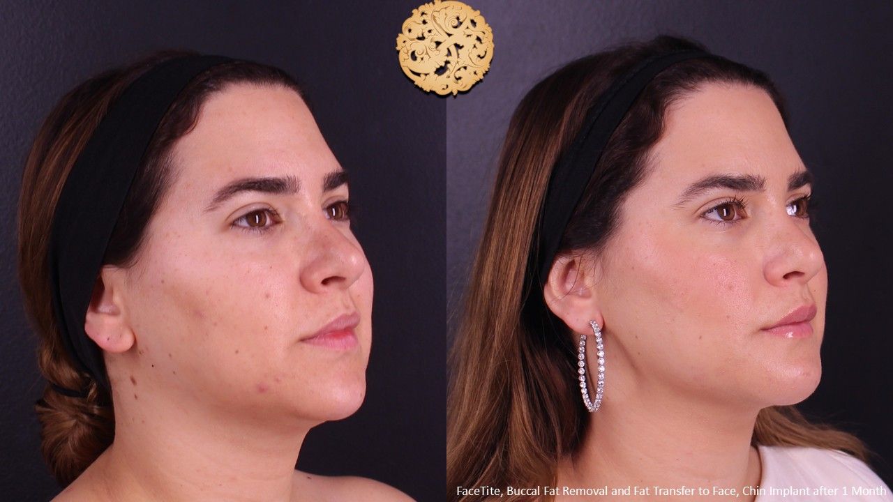 Buccal Fat Removal Before & After