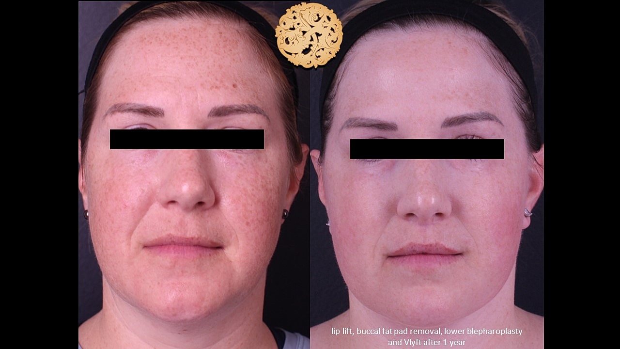 Before and after facial aesthetic procedure results.