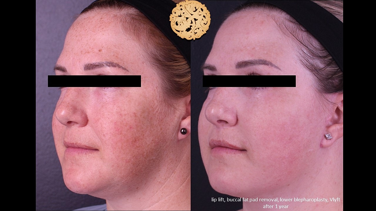 Before and after facial cosmetic procedures comparison.