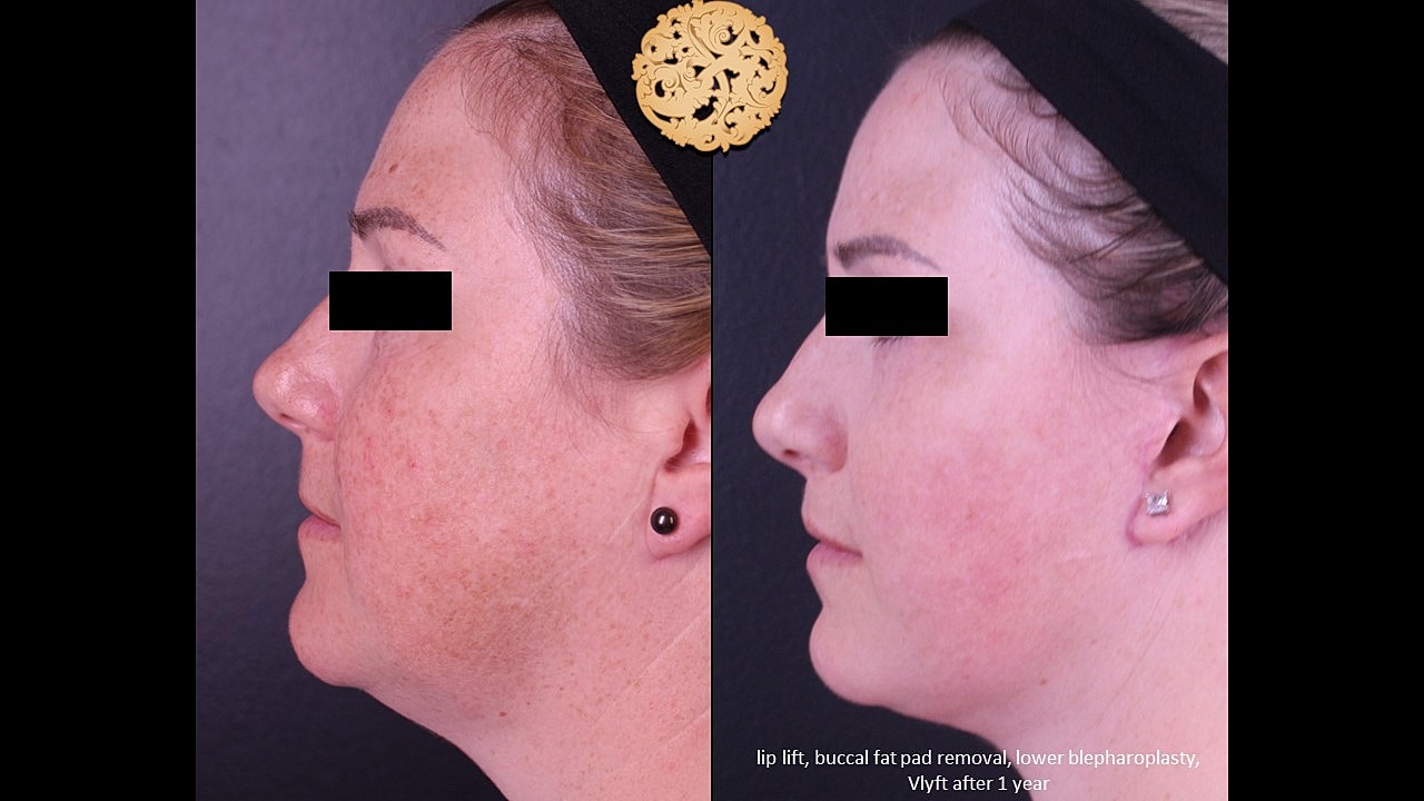 Before and after cosmetic facial procedures comparison.