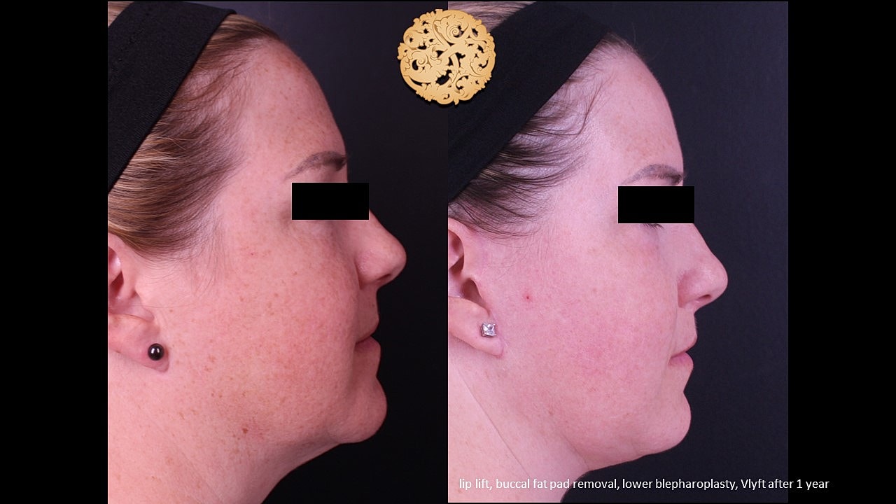 Before and after cosmetic surgery comparison image.
