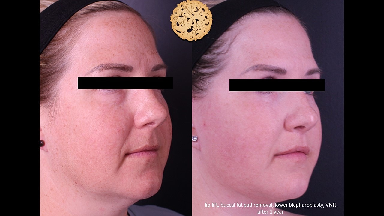 Before and after facial cosmetic procedures comparison.