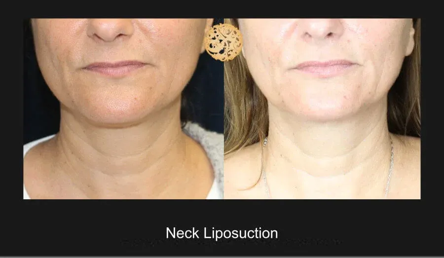 Neck Liposuction Before & After