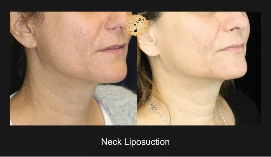 Neck Liposuction Before & After