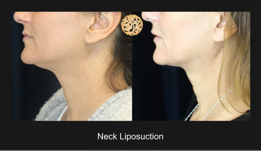 Neck Liposuction Before & After