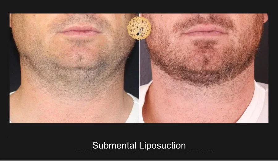 Neck Liposuction Before & After