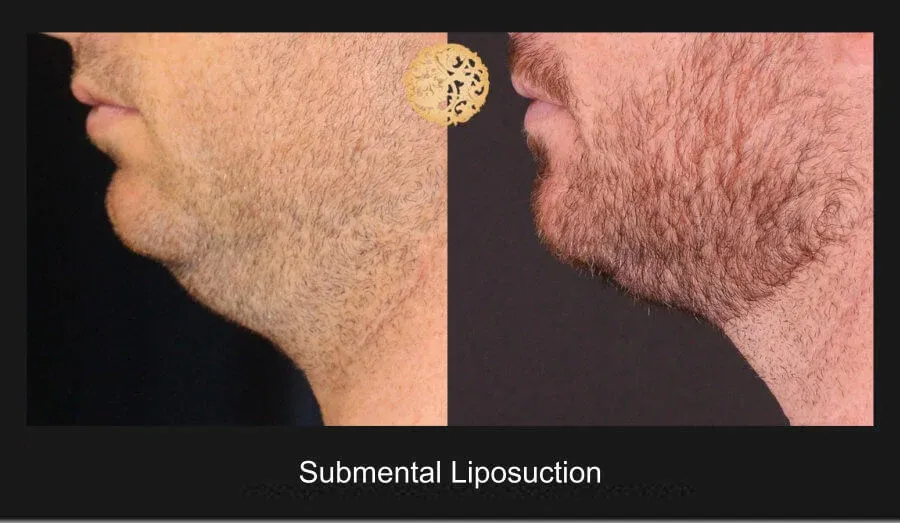 Neck Liposuction Before & After