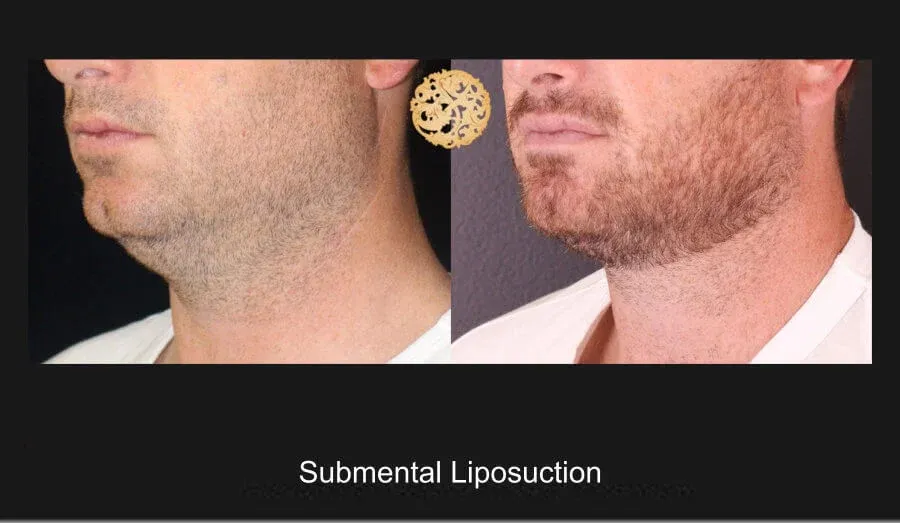 Neck Liposuction Before & After