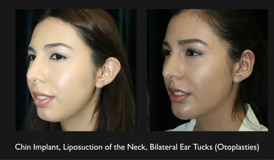 Neck Liposuction Before & After