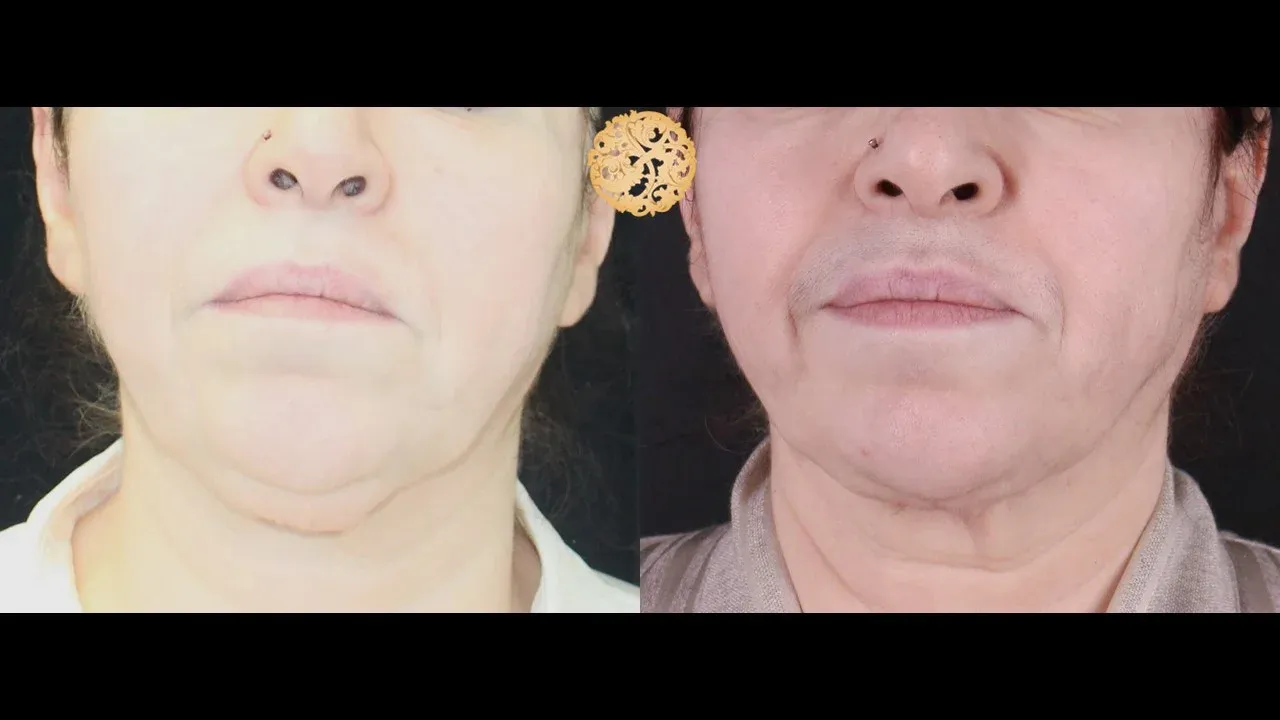 Neck Liposuction Before & After