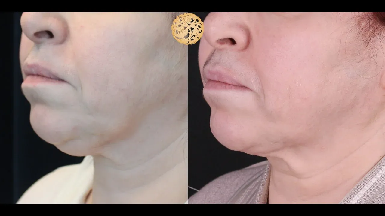 Neck Liposuction Before & After