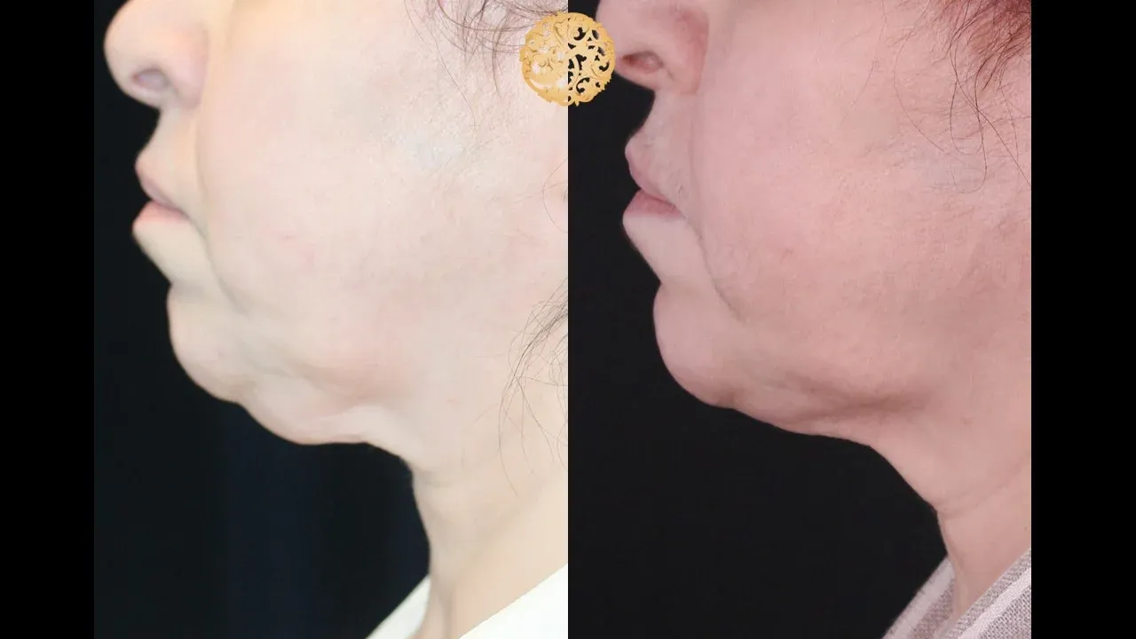 Neck Liposuction Before & After