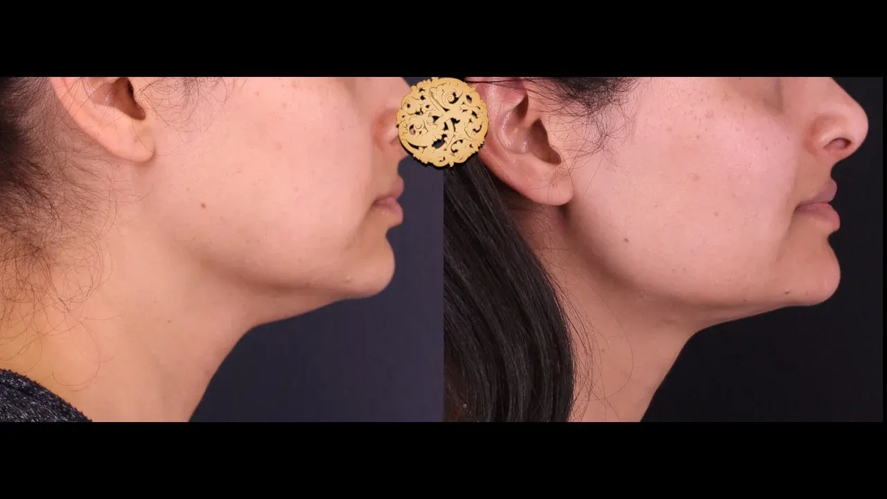 Neck Liposuction Before & After