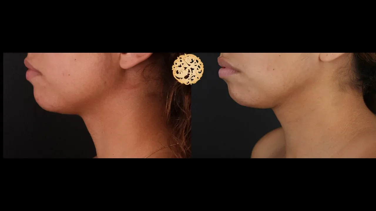 Neck Liposuction Before & After