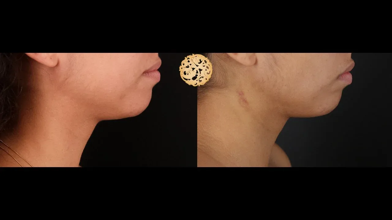 Neck Liposuction Before & After