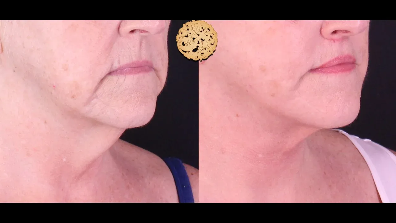 Neck Liposuction Before & After