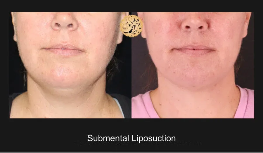 Neck Liposuction Before & After