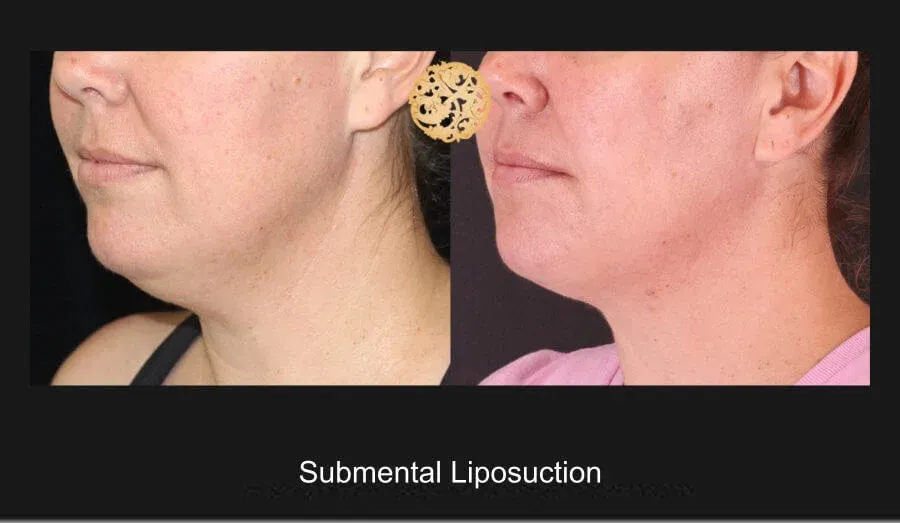 Neck Liposuction Before & After