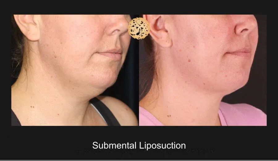 Neck Liposuction Before & After