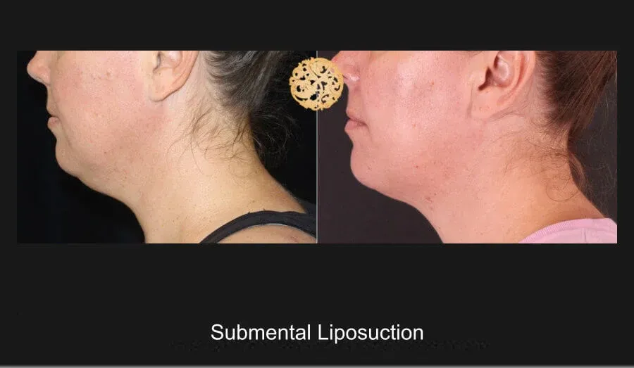 Neck Liposuction Before & After
