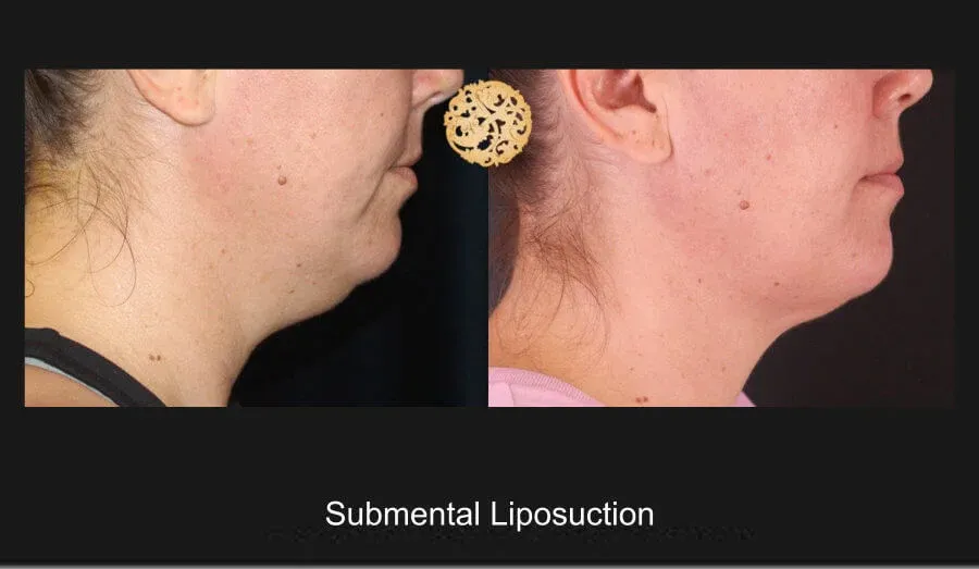 Neck Liposuction Before & After