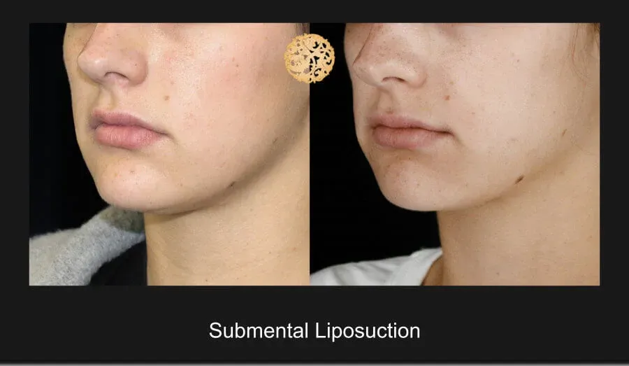 Neck Liposuction Before & After