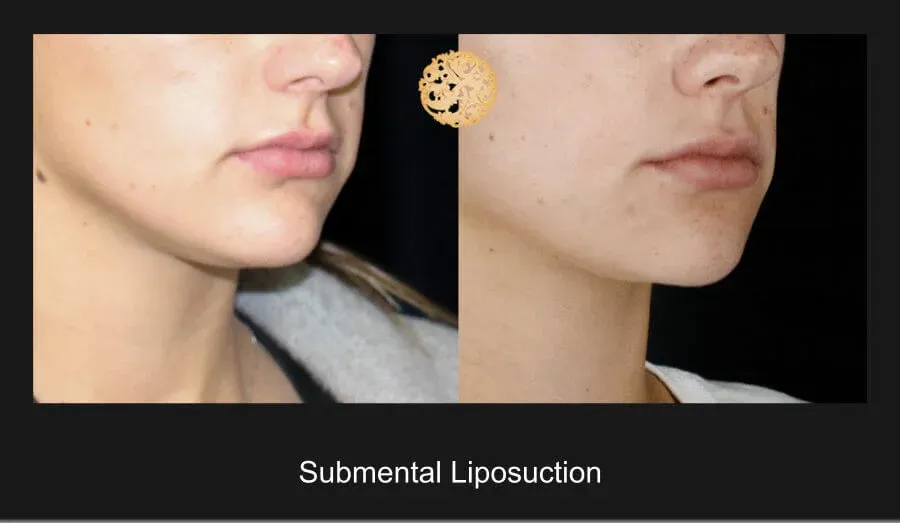 Neck Liposuction Before & After
