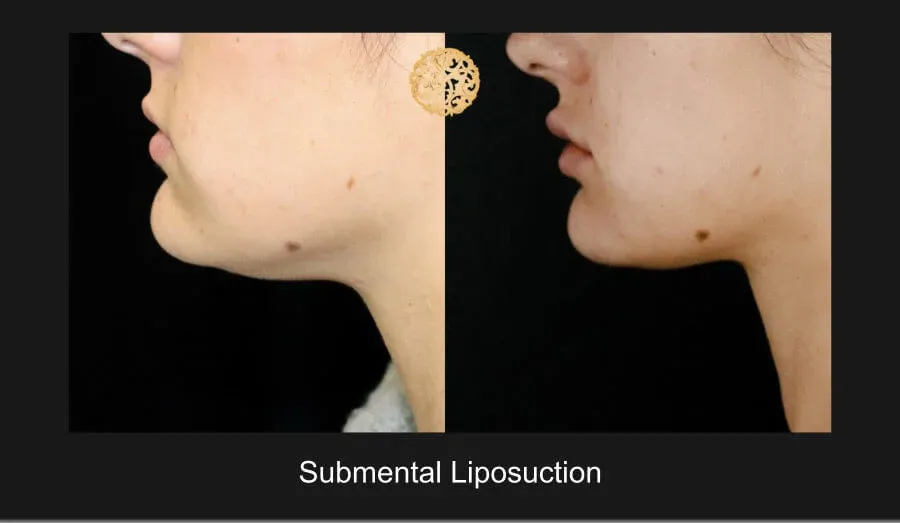 Neck Liposuction Before & After