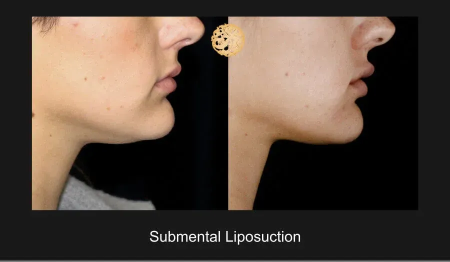Neck Liposuction Before & After