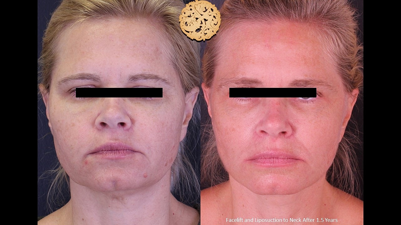 Before and after cosmetic surgery results.