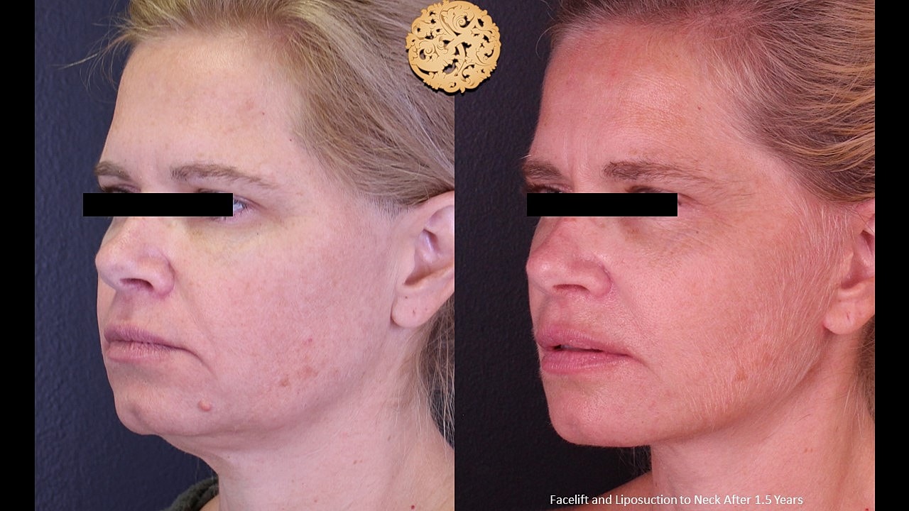 Before and after facelift and liposuction results.