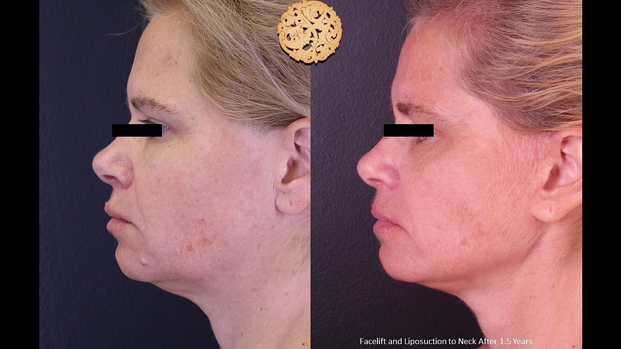 Facelift and liposuction results, before and after.