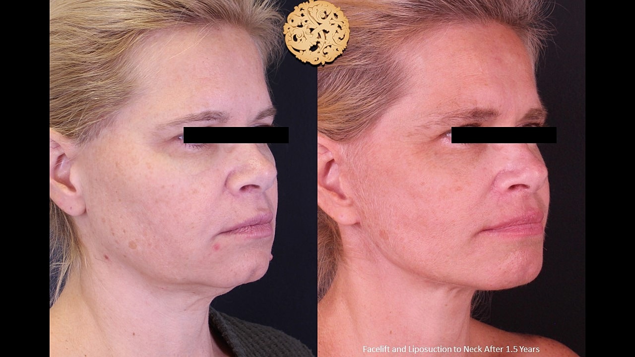 Before and after facelift and liposuction images.