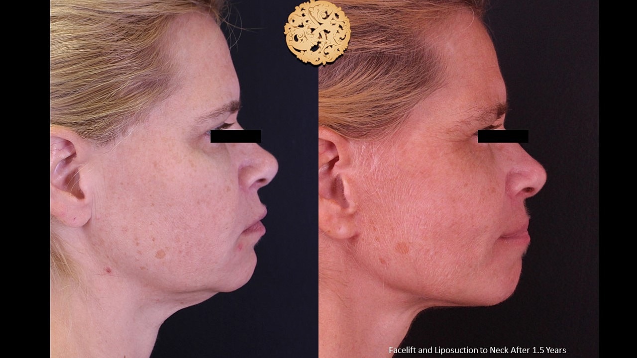 Facelift and neck liposuction before and after comparison.