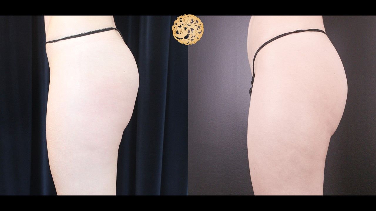 Non Surgical Butt Augmentation Before & After