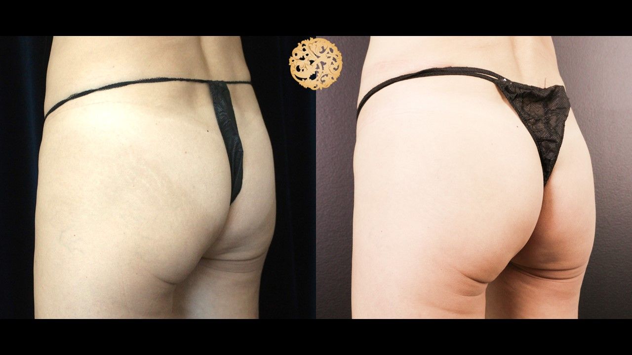 Non Surgical Butt Augmentation Before & After