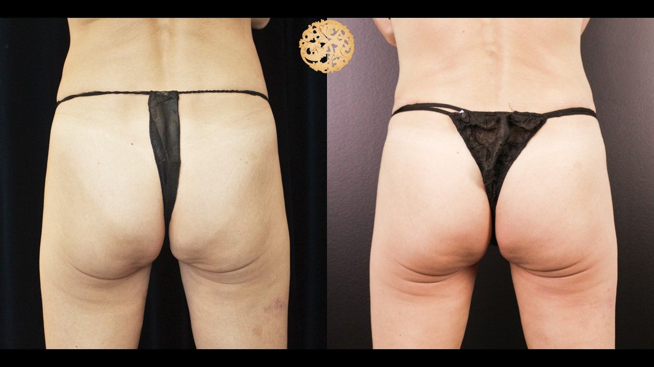 Non Surgical Butt Augmentation Before & After