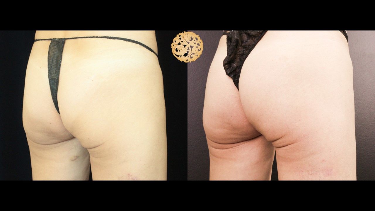Non Surgical Butt Augmentation Before & After