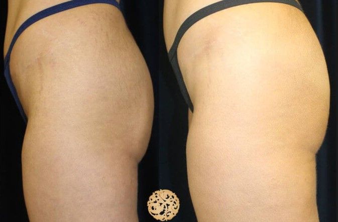 Non Surgical Butt Augmentation Before & After