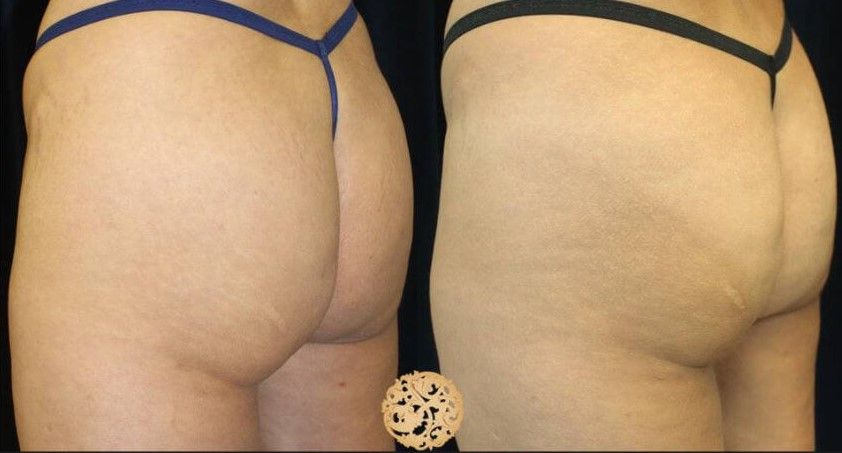 Non Surgical Butt Augmentation Before & After