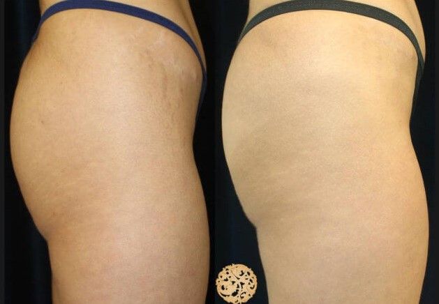 Non Surgical Butt Augmentation Before & After